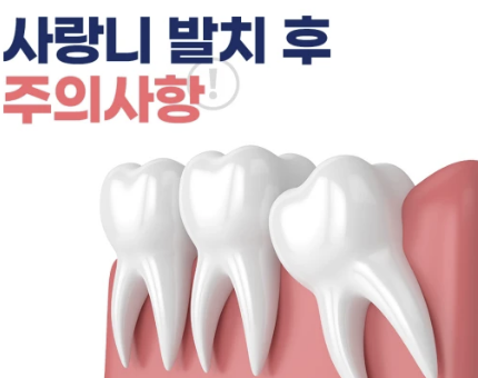 사랑니 발치후 식사 통증 술 담배 등 확인(25ver)