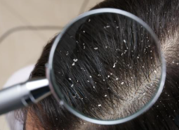 지루성 두피염1