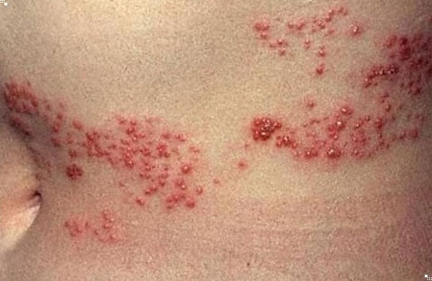 대상포진 초기증상