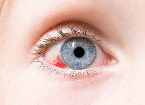 눈 핏줄이 생기면