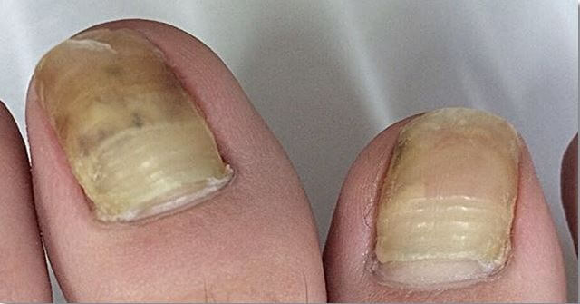 발톱 무좀 상태
