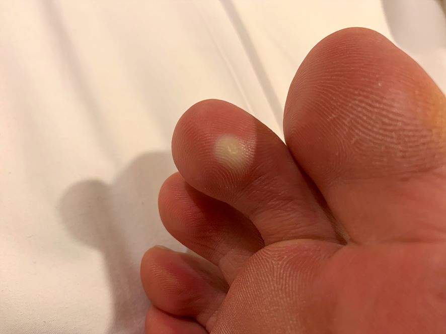 앤드와츠 사마귀 치료제를 바르고 3일 뒤