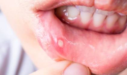 잇몸 헤르페스는 흔한 구강 질환