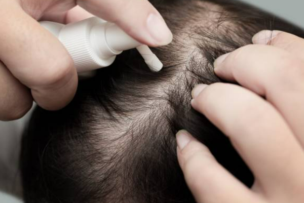 미녹시딜 사용방법