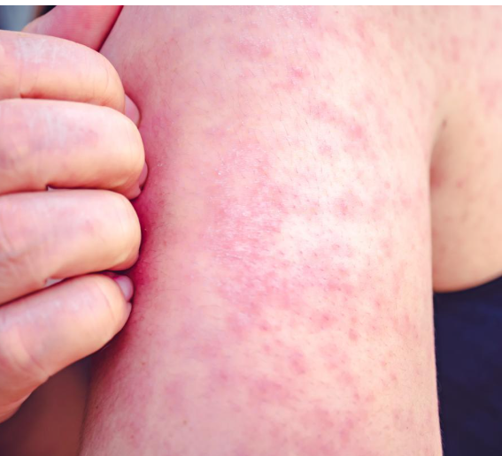 홍역 증상 완벽 가이드