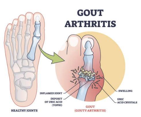 통풍 초기증상 치료법, 좋은 음식에 대한 모든 것 확인