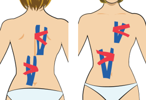 척추 측만증 (등이 우측으로 휠 때)