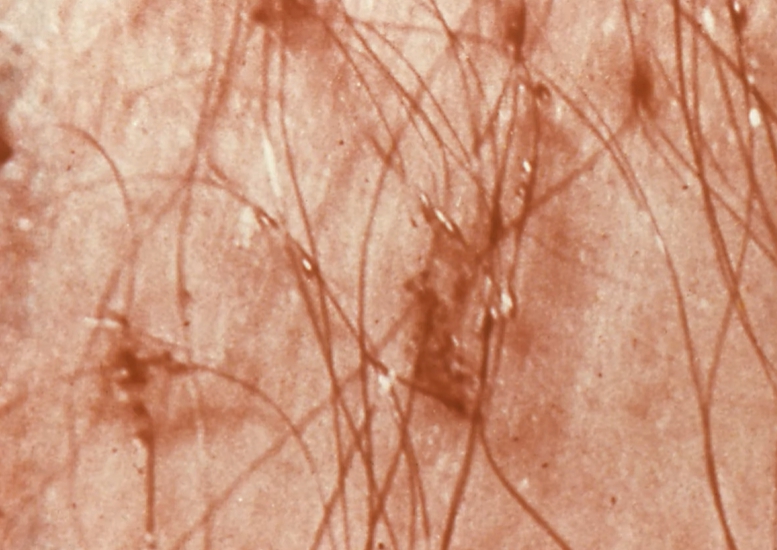 사타구니 가려움증