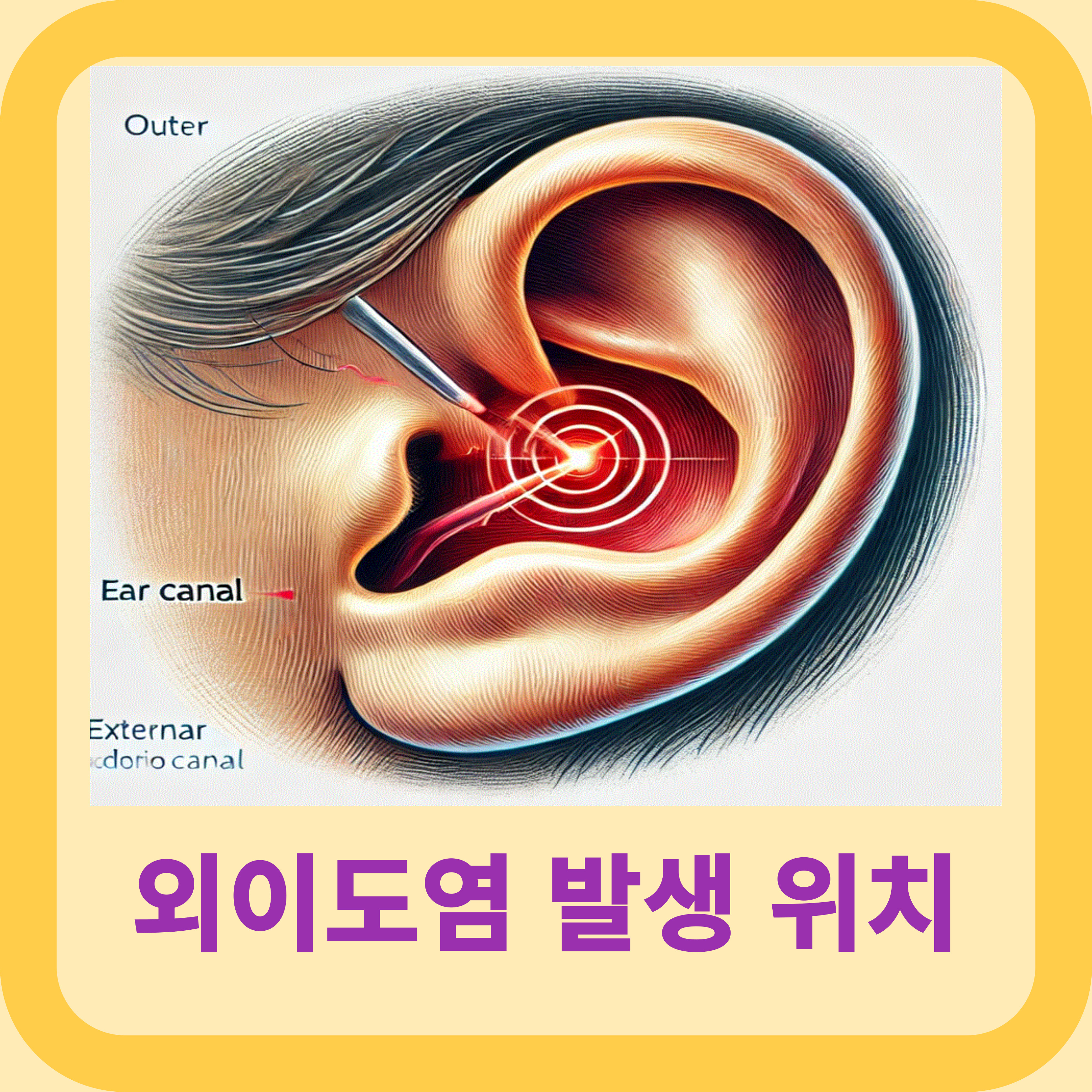 외이도염의-위치와-염증이-있는-귀-내부-구조