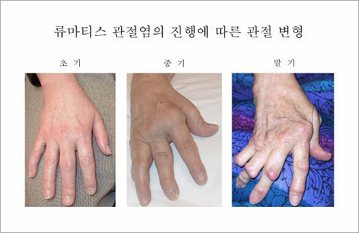류마티스 관절염 초기증상