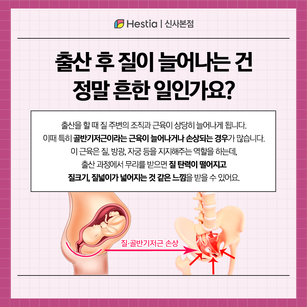출산 후 질늘어남, 흔한 일인가요?