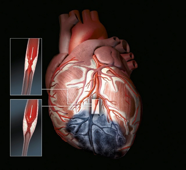 심근경색 전조증상