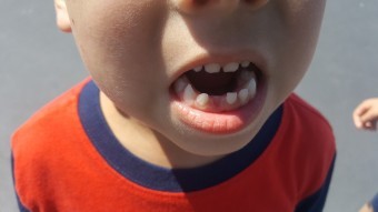 붉은-옷을-입은-아이-아랫니가-빠져있는-모습