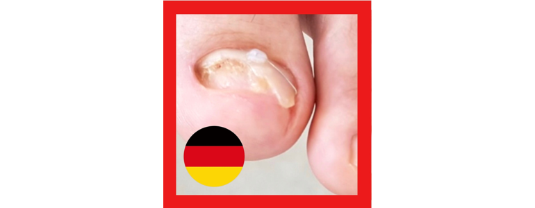 파주시 내성발톱