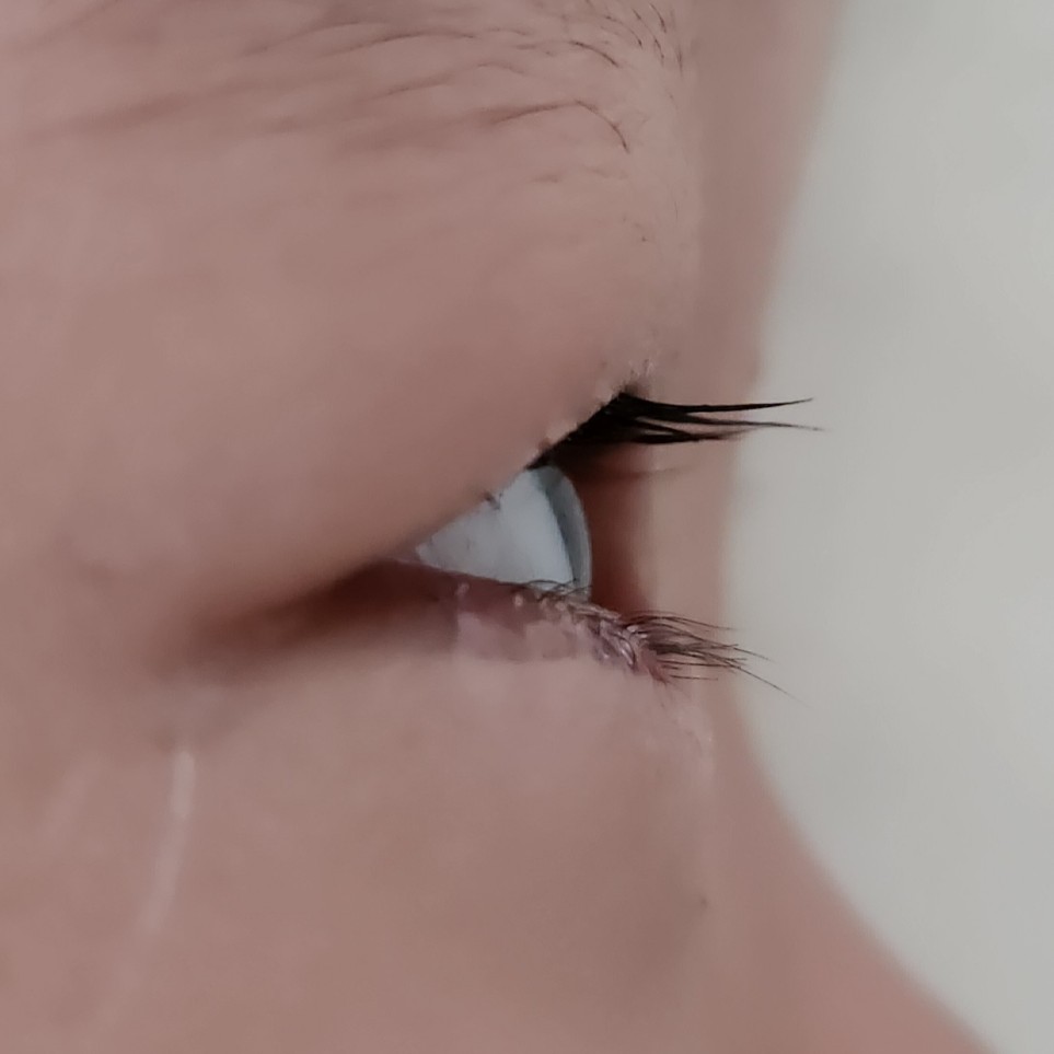 수술 3일 후 눈 옆모습