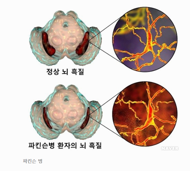파킨슨병 초기 증상 환자와 가족이 알아야 할 모든 것