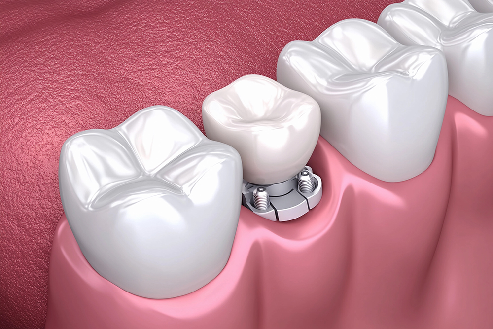 임플란트 시술과정