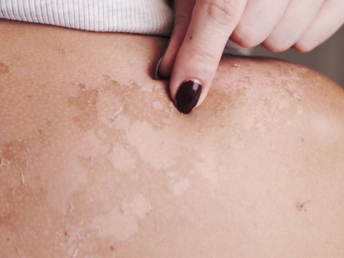 비타민 B3 부족증상