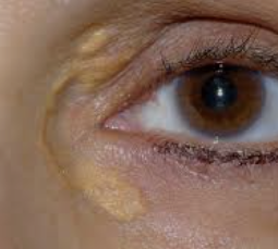 고지혈증 증상 6