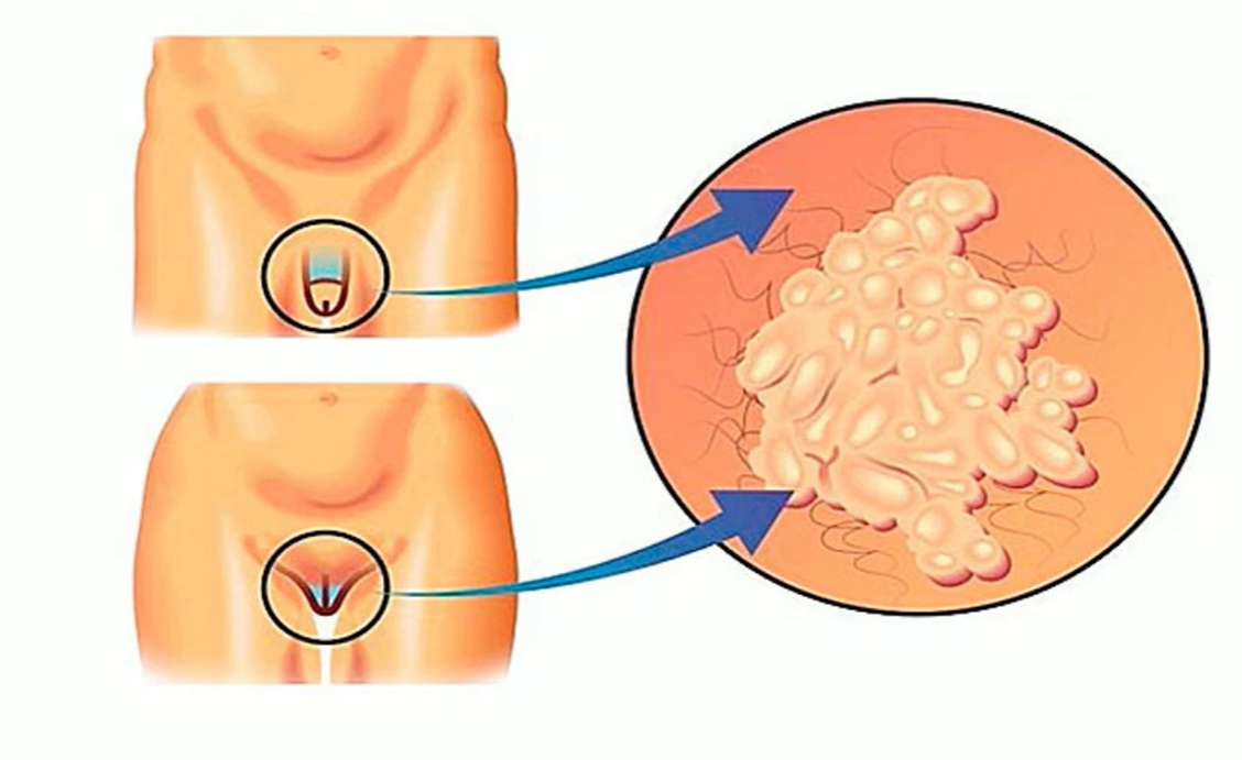 hpv 바이러스 증상