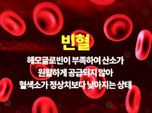 빈혈-사진