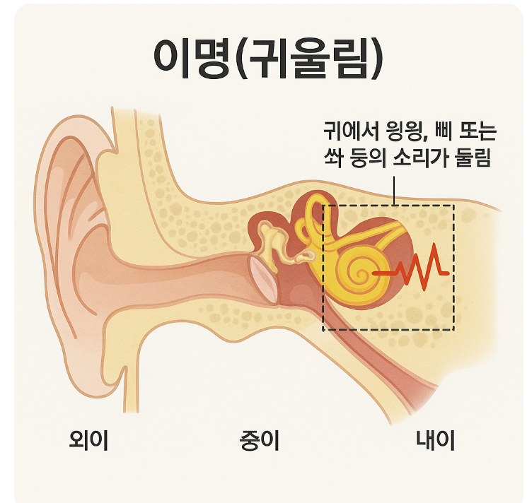 이명-원인-구조