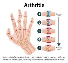 손가락 관절염 초기증상