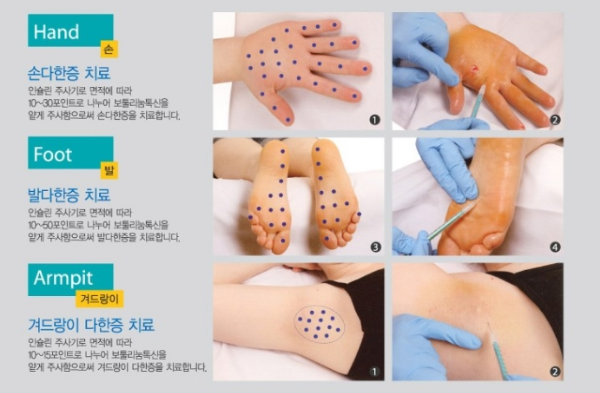 다한증 치료