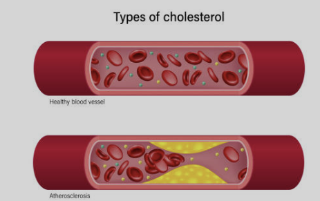 고지혈증에 좋은 음식 나쁜 음식 관리방법 파헤치기