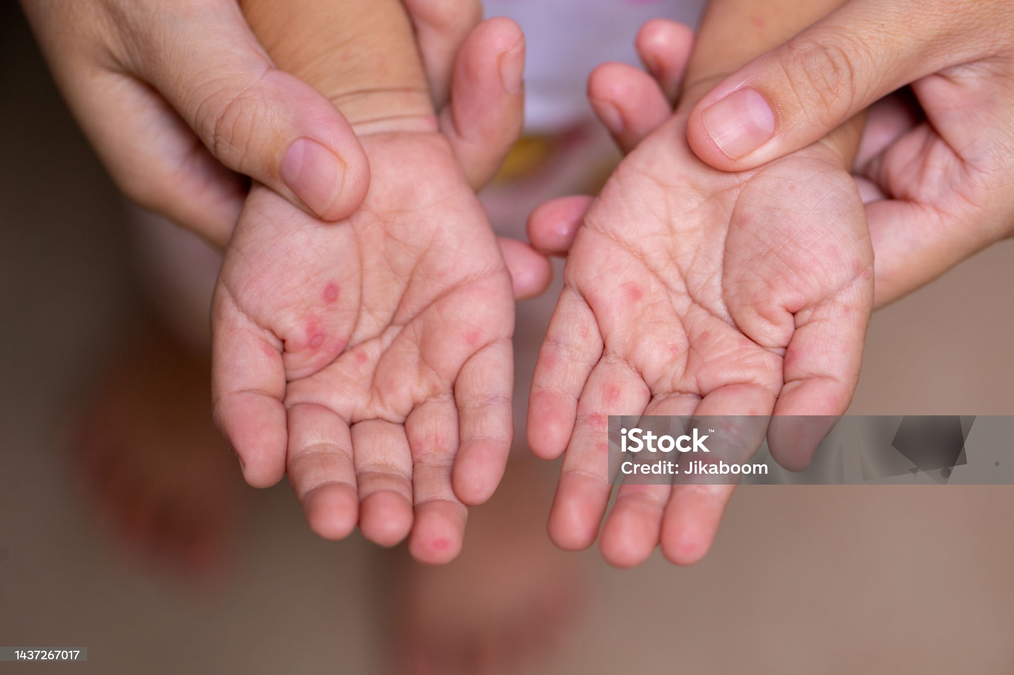 수족구병-관련-사진