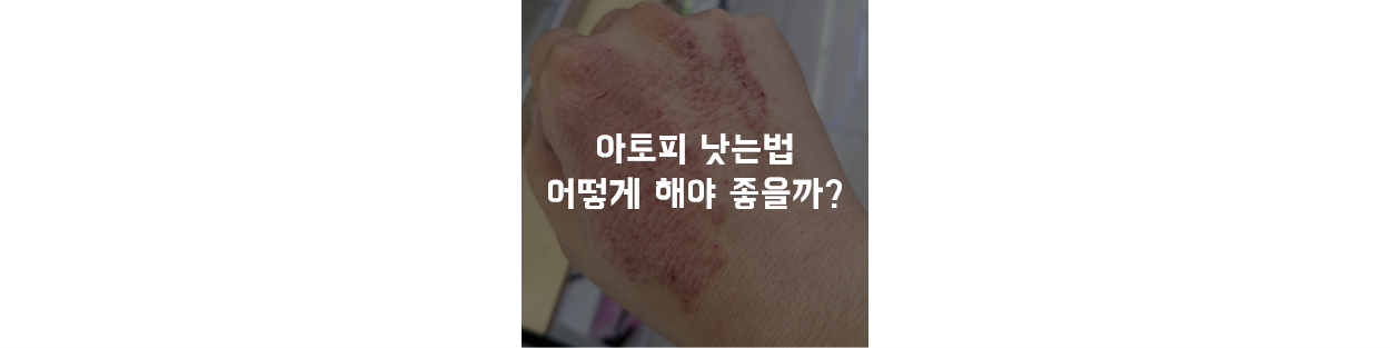아토피 낫는법&#44; 아토피 관리&#44; 아토피 치료&#44; 아토피 치료 부작용