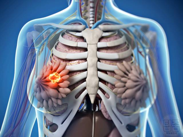 모계유전 질병 유방암 난소암