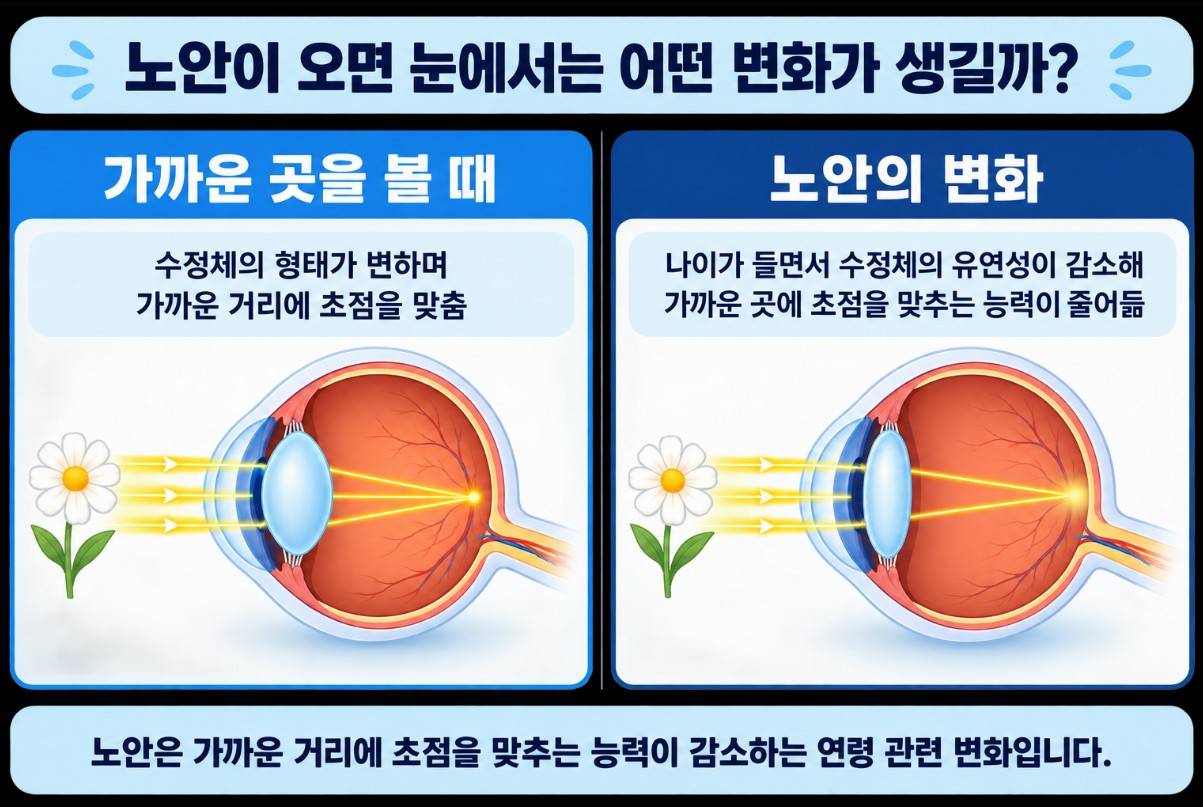 노안으로 수정체의 유연성이 감소하면서 가까운 곳의 초점을 맞추기 어려워지는 변화