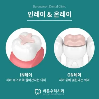 인레이 온레이의 차이와 치료 방법_6
