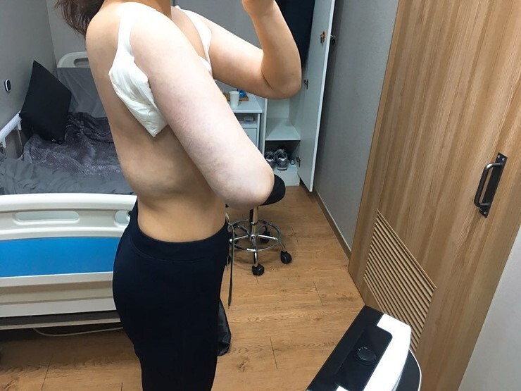 팔뚝지방흡입 후기