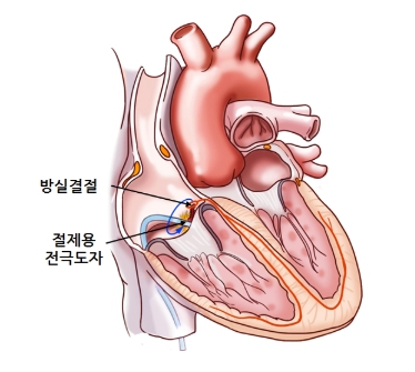 도관을 이용한 절제술(고주파 전극도자 절제술)