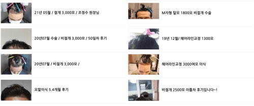 모제림모발이식후기