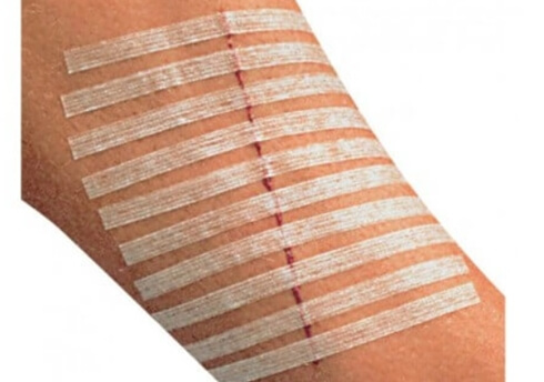 갑상선암 수술 부위 스테리 스트립