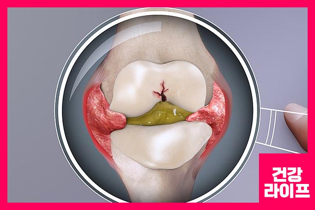 류마티스 인자 수치