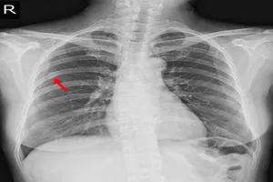 가슴-통증-원인