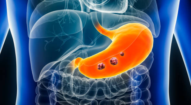 위암 초기증상, 수술비용, 수술후 회복기간 총정리 (2024ver)