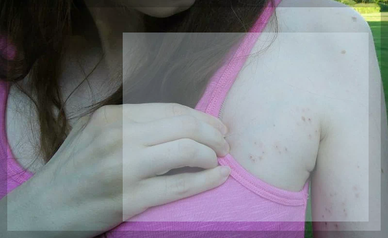 겨드랑이 대상포진