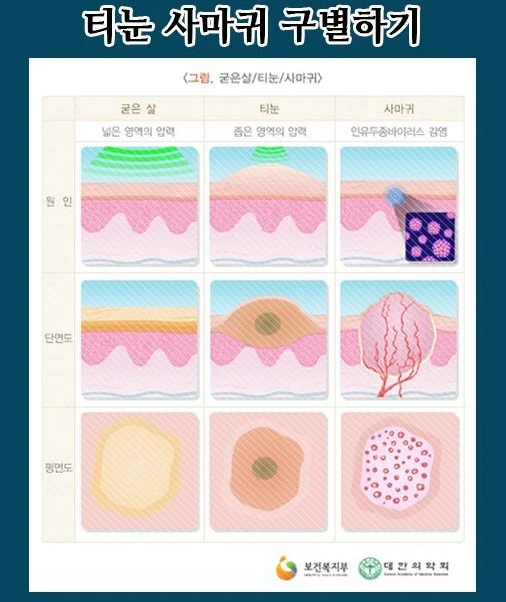 티눈과 사마귀 구별하는 방법