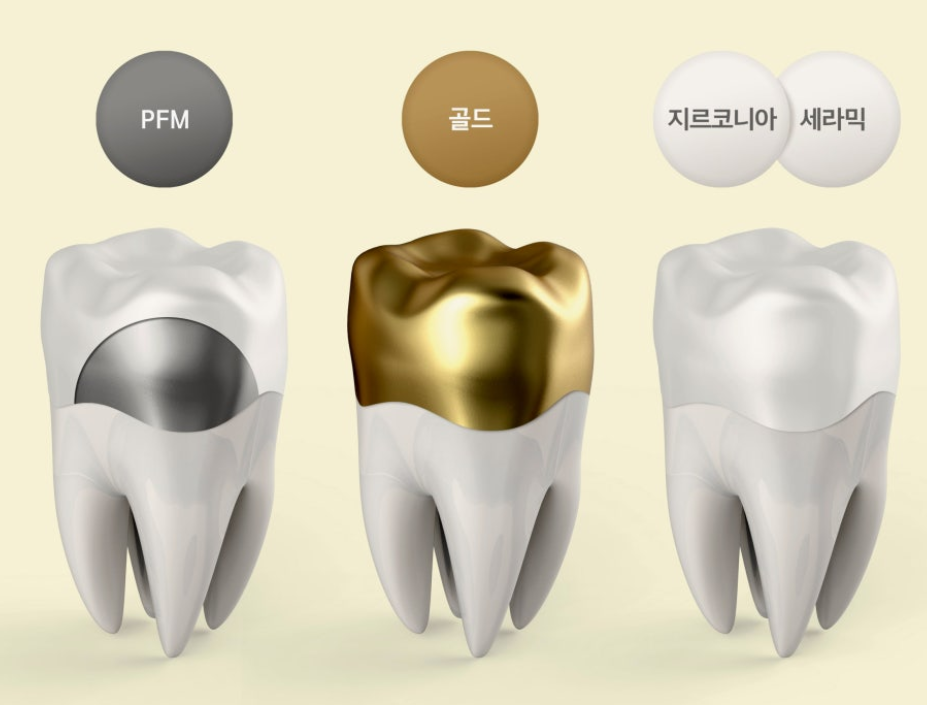 크라운치료-사진4