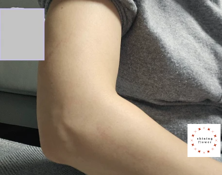 테니스엘보 부위-내사진