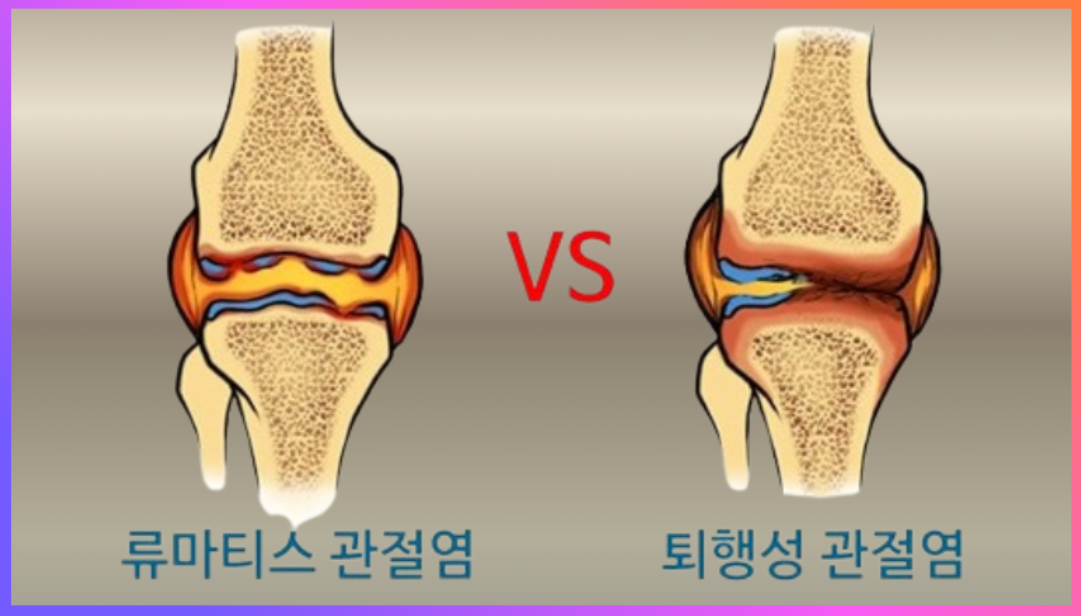 류마티스 관절염과 퇴행성 관절염의 차이를 보여주는 관절 비교 이미지