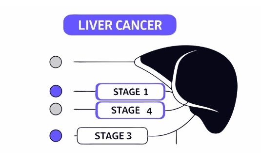 간암 치료 과정