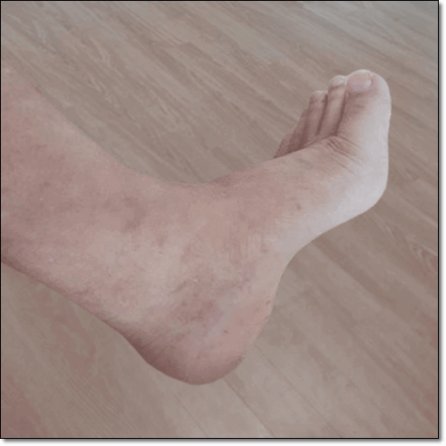 발등이 붓는 이유