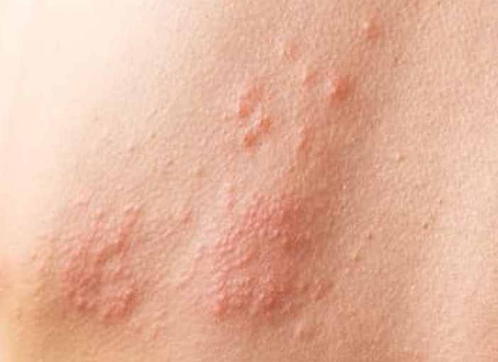 대상포진 초기증상