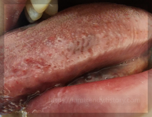 좌측에서 바라본 혀에 검은 점